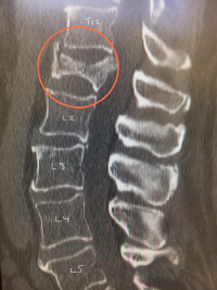 Osteoporotic Vertebral Fractures Spines Dorset