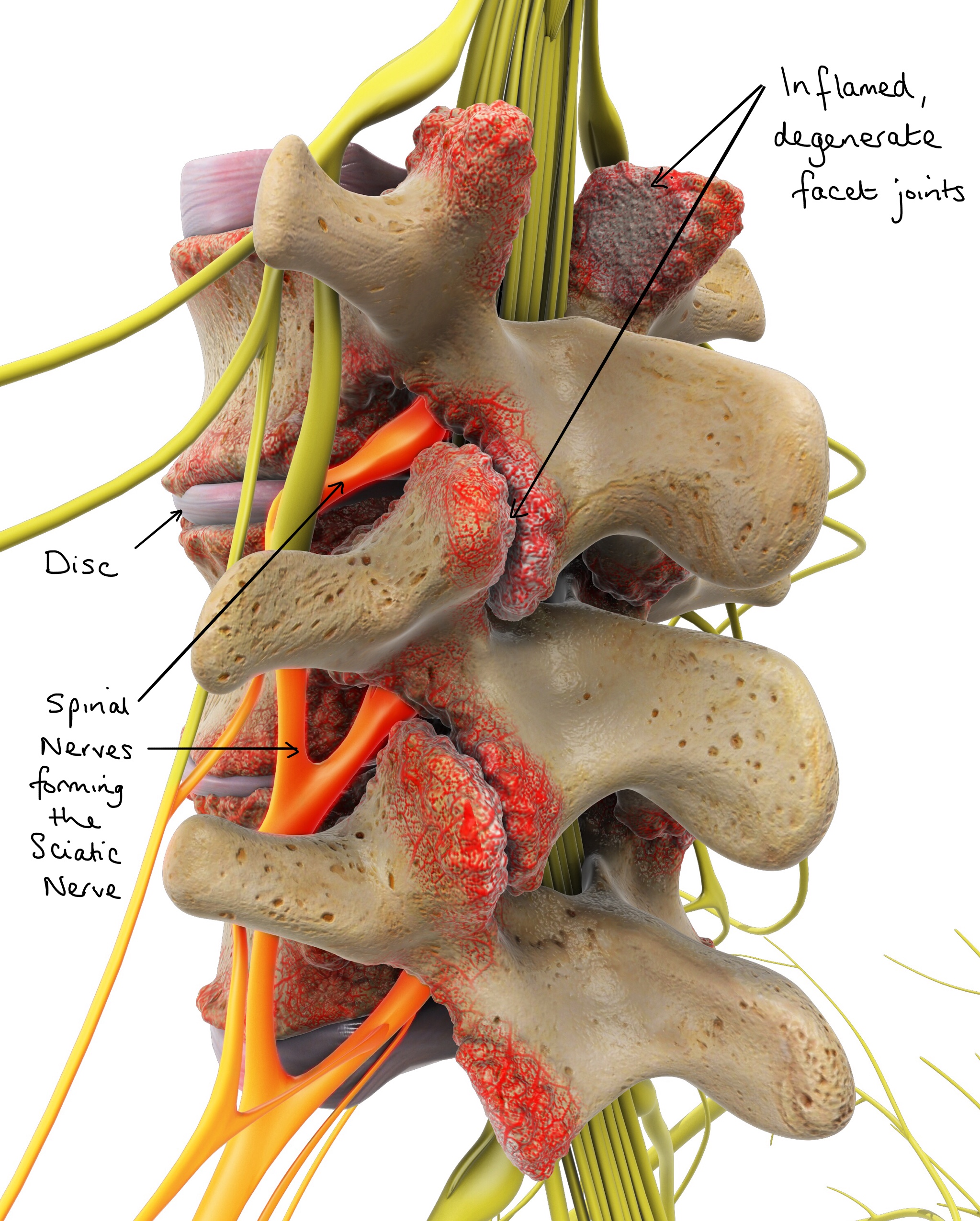 Degenerative Joint Disease Other Term