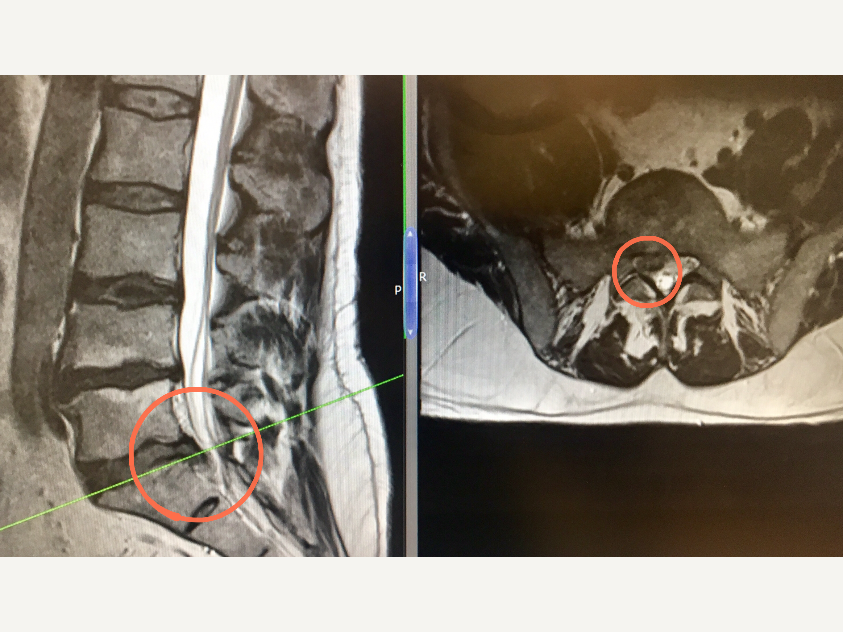 discectomy before and after