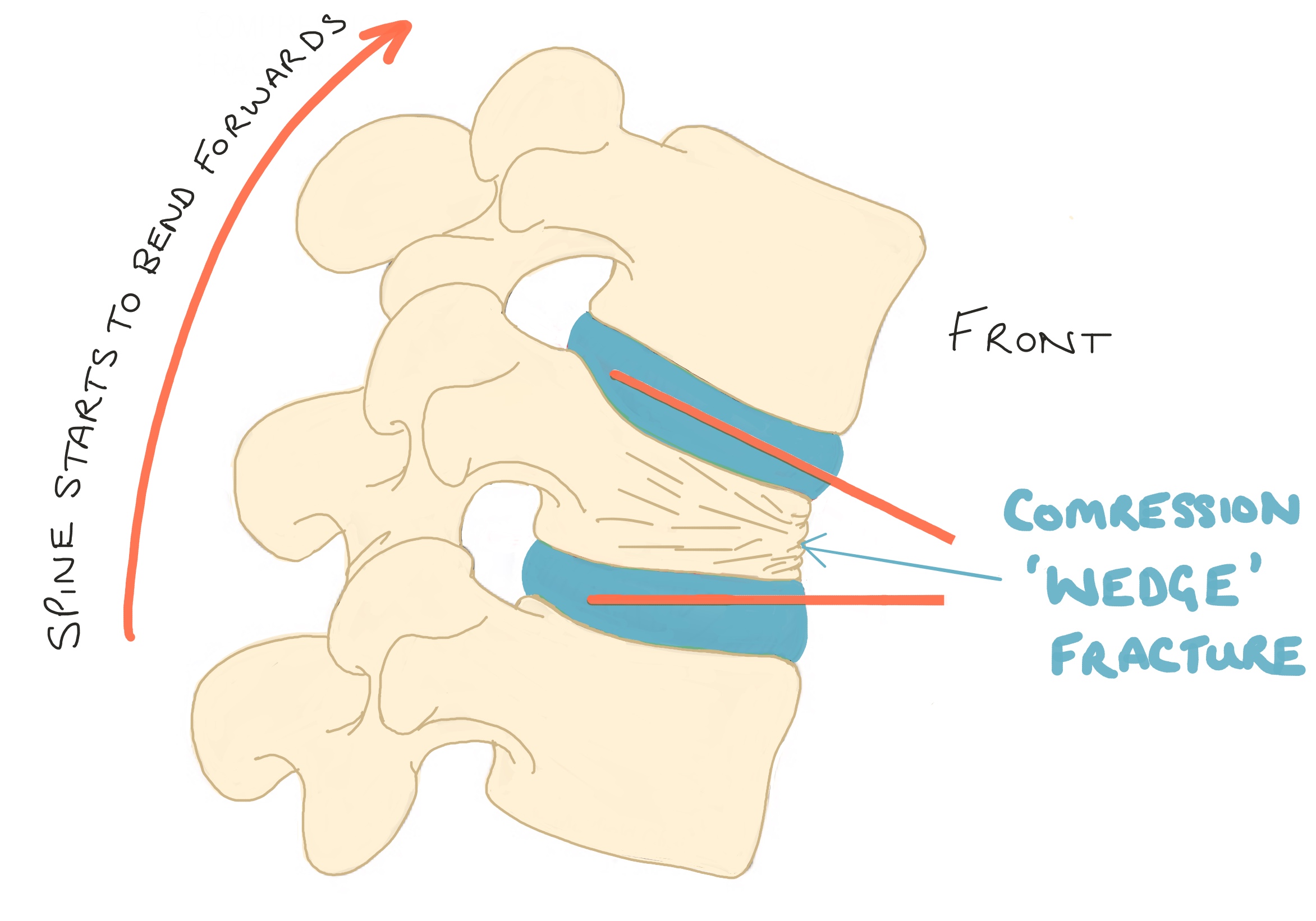 compression-fracture-diagram