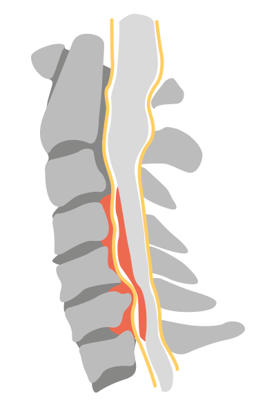 can cervical myelopathy cause death