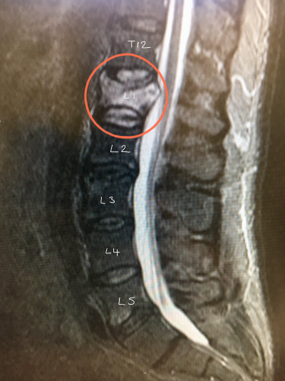 Kyphoplasty - Spines Dorset