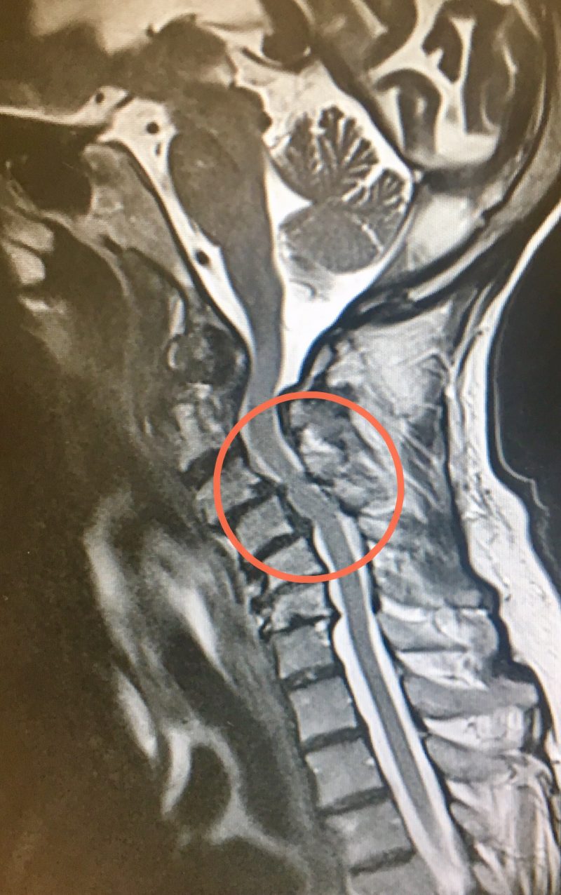 Myelopathy spines dorset