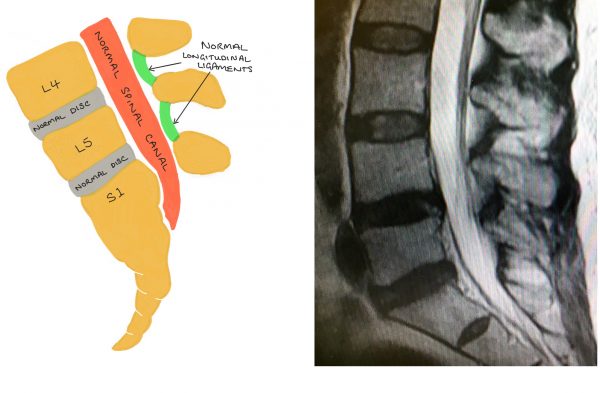 Spinal Stenosis Spines Dorset 6153