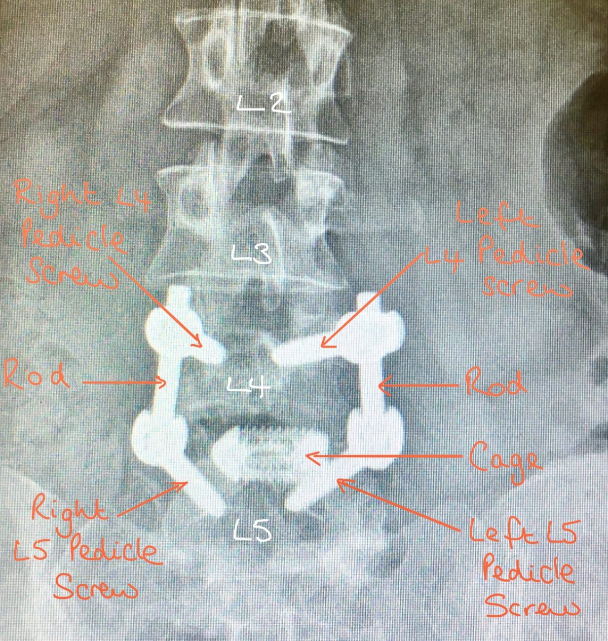 Lumbar Posterior Instrumented Fusion Spines Dorset