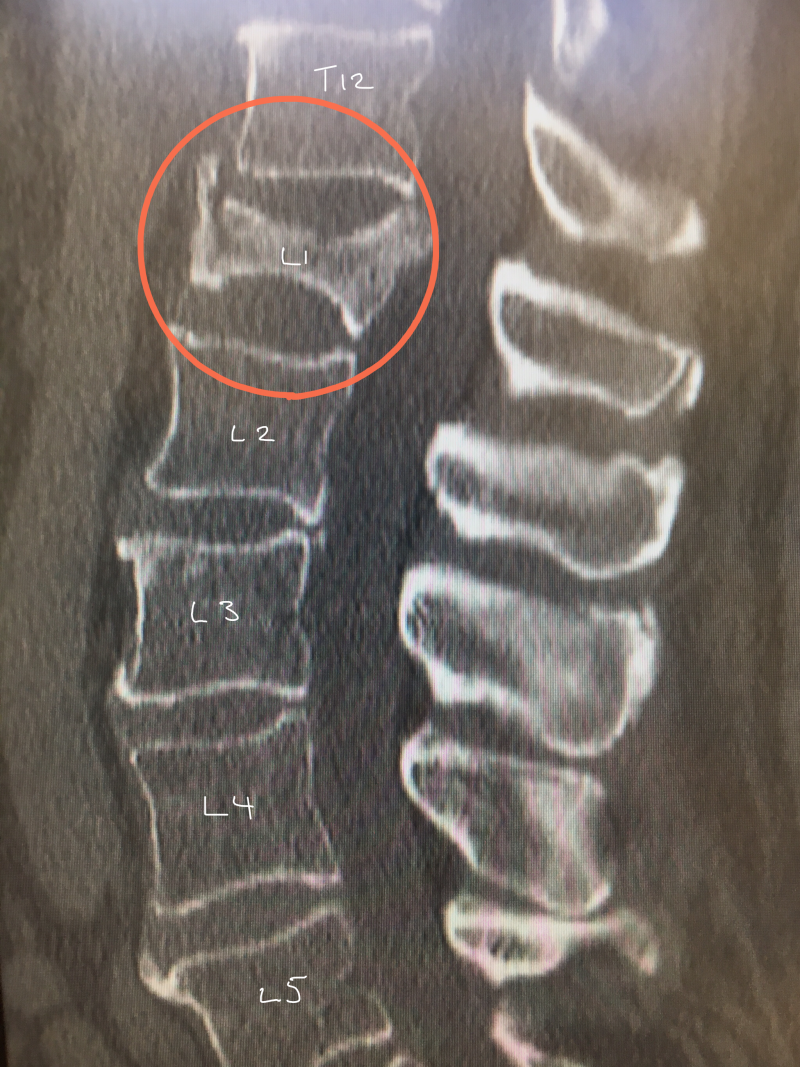 Osteoporotic Vertebral Fractures - Spines Dorset