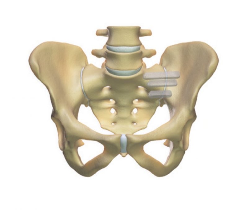 Sacro-Iliac Joint Fusion - Spines Dorset