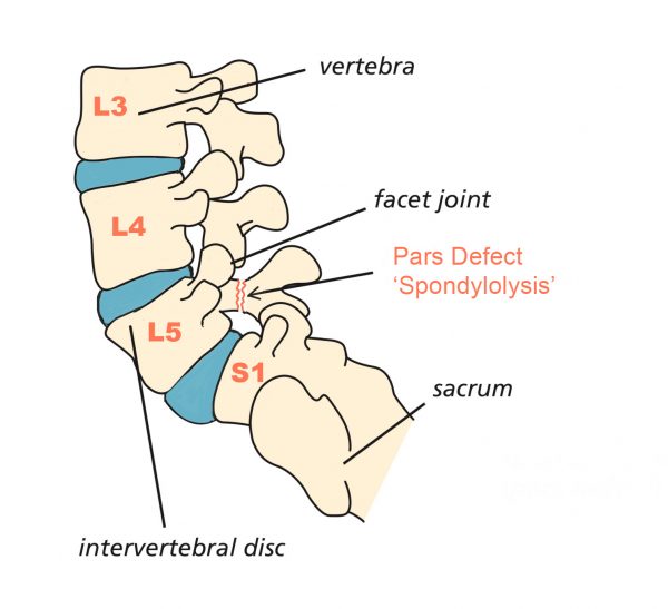 Pars Defect Injection Spines Dorset