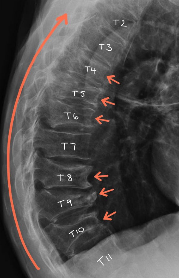 Mri Of Lumbar Thoracic Spine Show Fracture Of Thoraci - vrogue.co