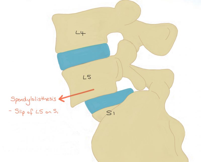 Lumbar Posterior Instrumented Fusion - Spines Dorset