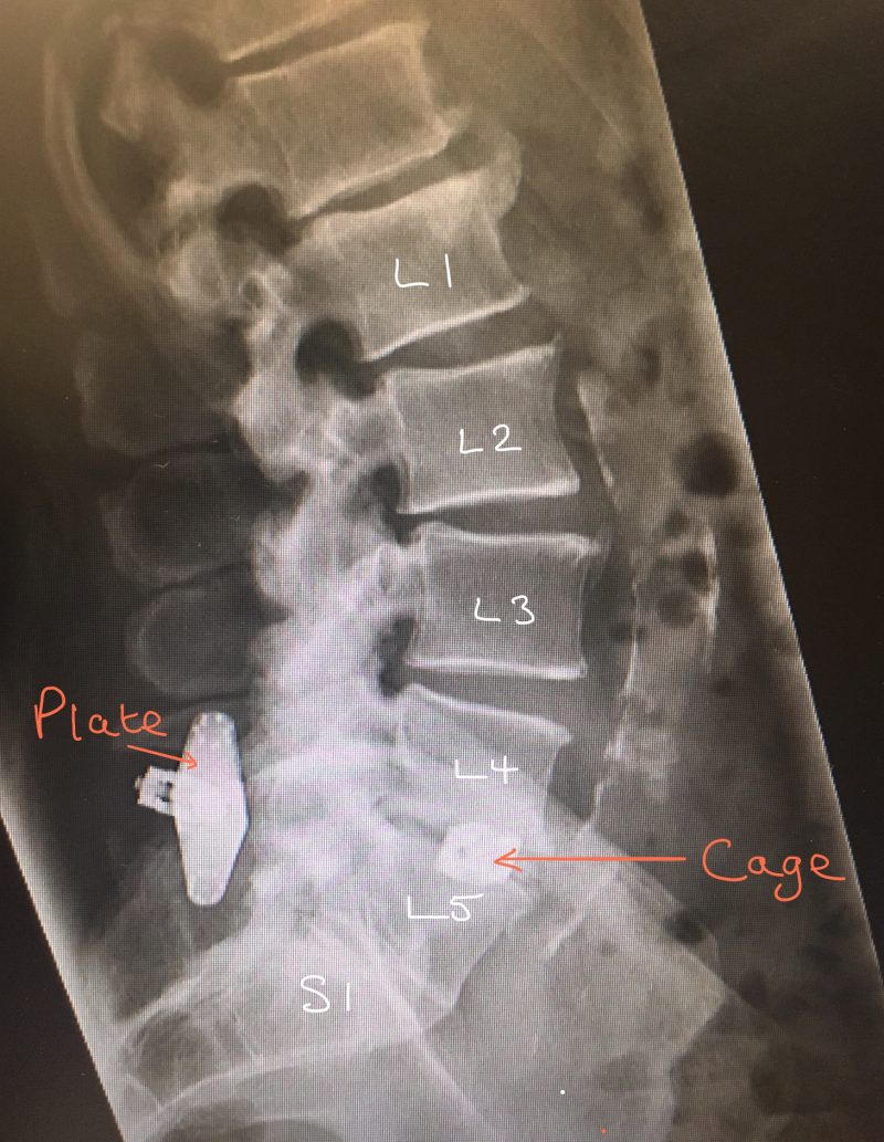 Lumbar Posterior Instrumented Fusion Spines Dorset