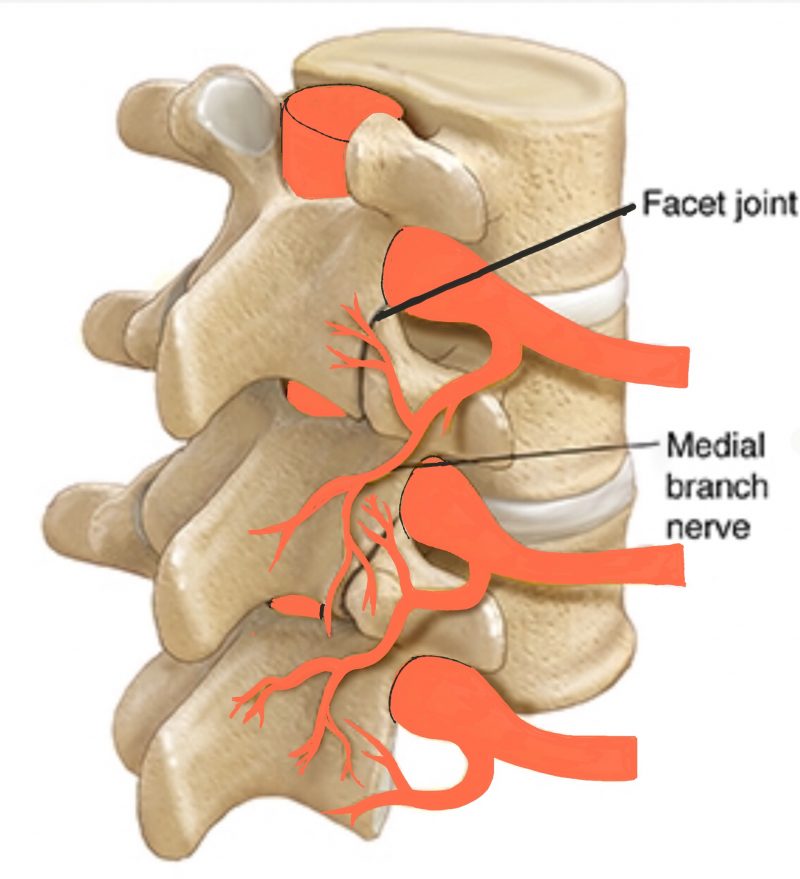 facet-joint-denervation-spines-dorset