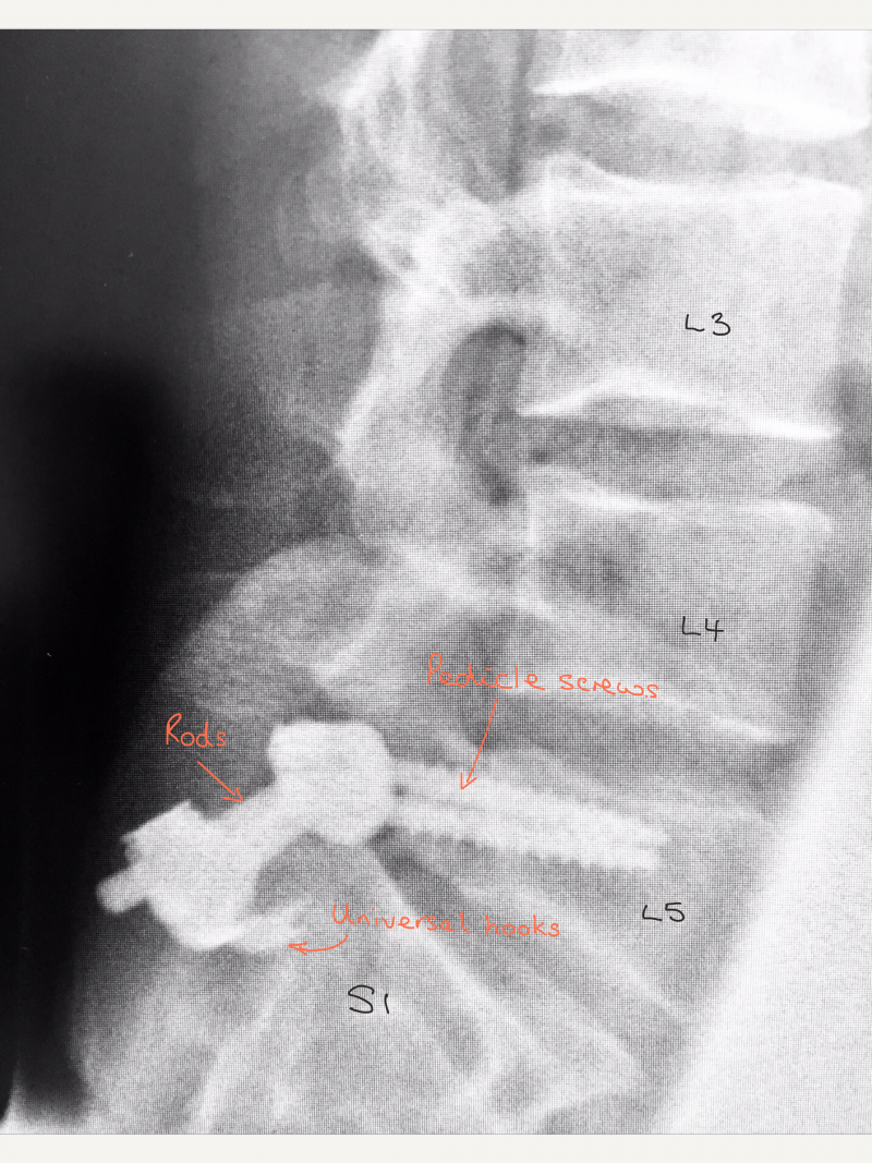 pars-defect-repair-spines-dorset