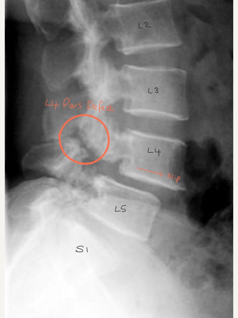 Pars Defect Repair - Spines Dorset